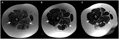 Case Report: Advanced Skeletal Muscle Imaging in S-Adenosylhomocysteine Hydrolase Deficiency and Further Insight Into Muscle Pathology